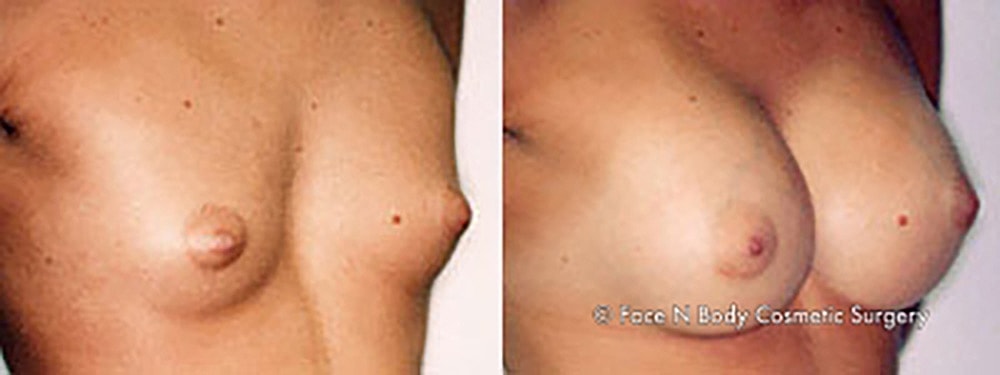 Breast Augmentation Before & After