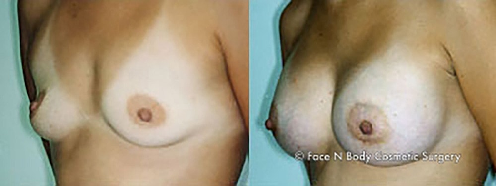Breast Augmentation Before & After