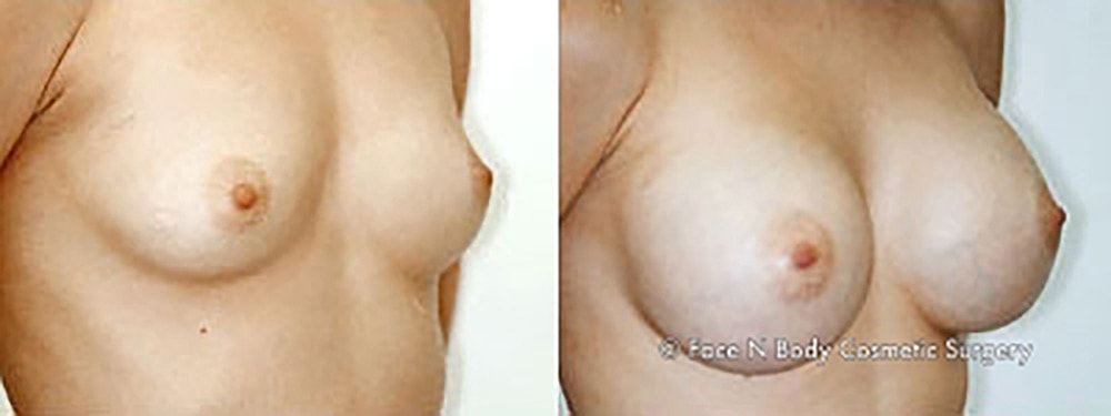 Breast Augmentation Before & After