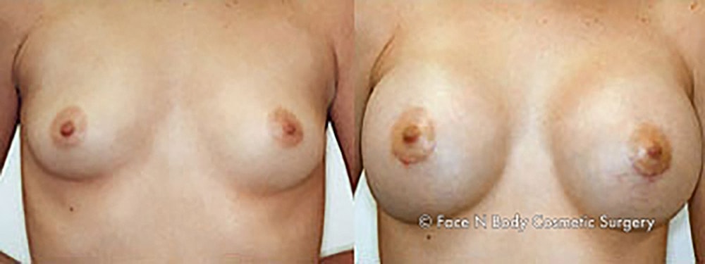 Breast Augmentation Before & After