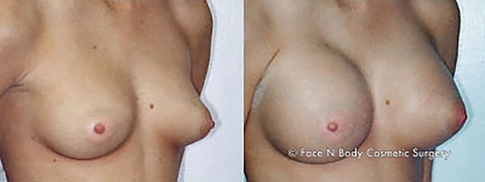 Breast Augmentation Before & After