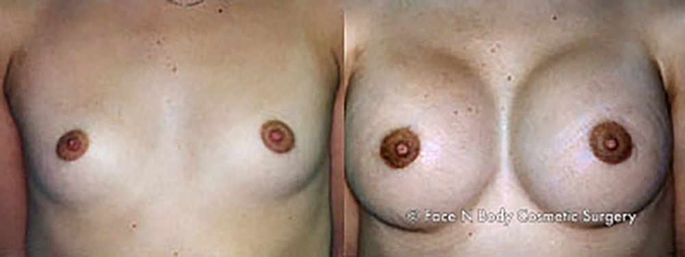 Breast Augmentation Before & After