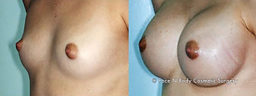 Breast Augmentation Before & After