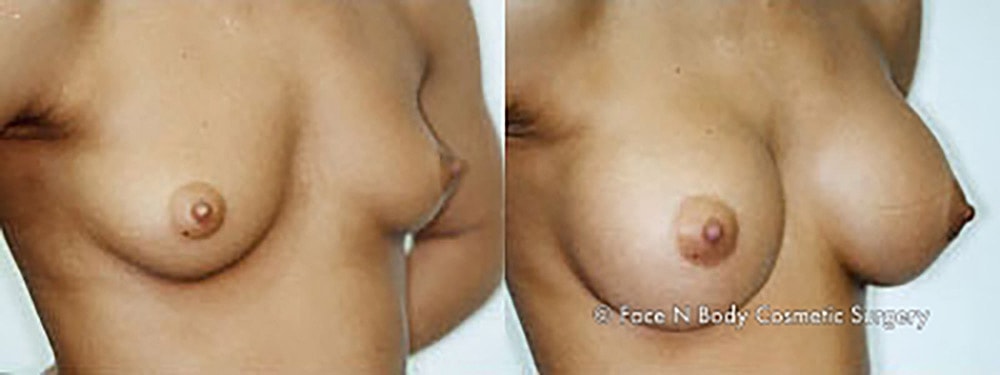 Breast Augmentation Before & After