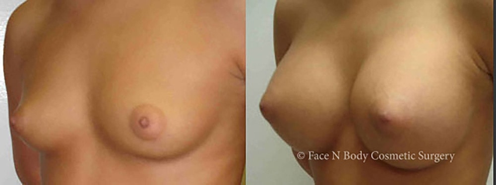 Breast Augmentation Before & After