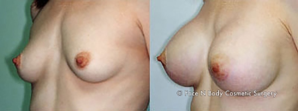 Breast Augmentation Before & After