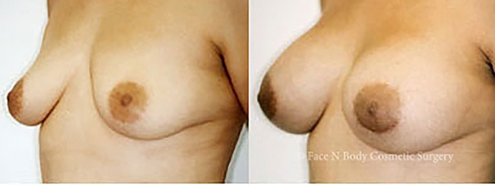 Breast Augmentation Before & After
