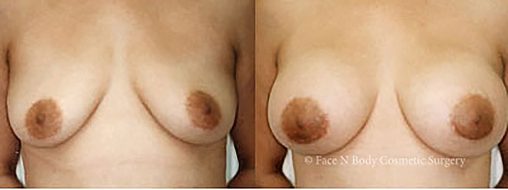 Breast Augmentation Before & After