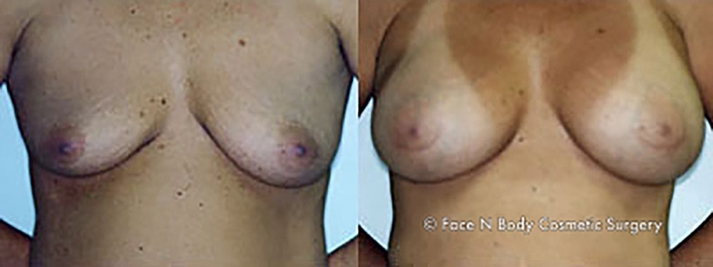Breast Augmentation Before & After