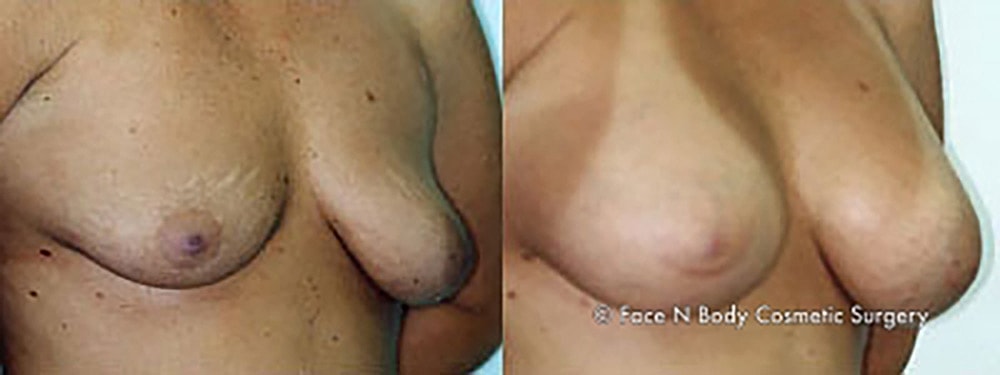 Breast Augmentation Before & After