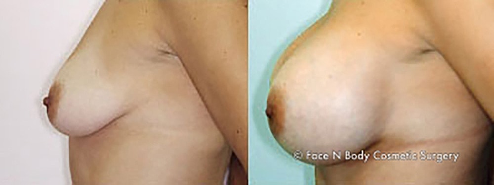 Breast Augmentation Before & After