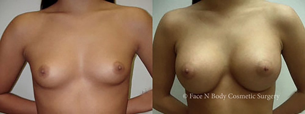 Breast Augmentation Before & After