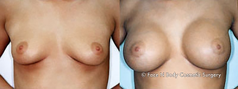 Breast Augmentation Before & After