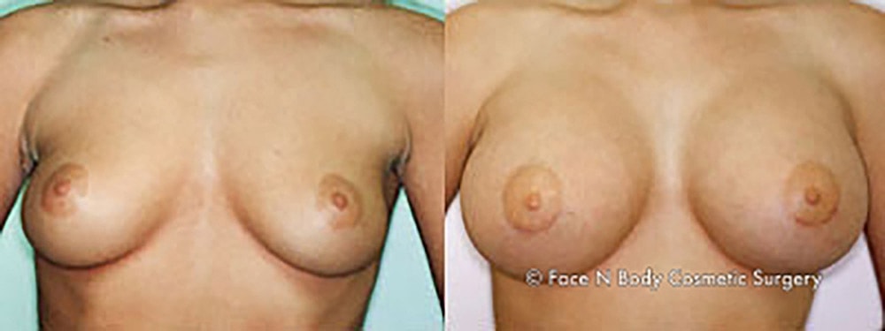 Breast Augmentation Before & After
