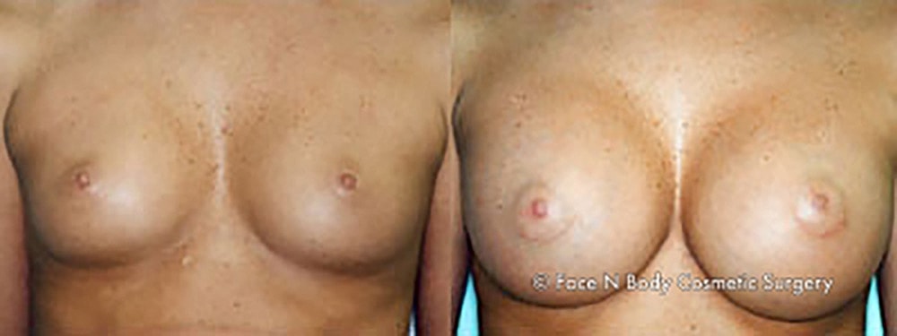 Breast Augmentation Before & After