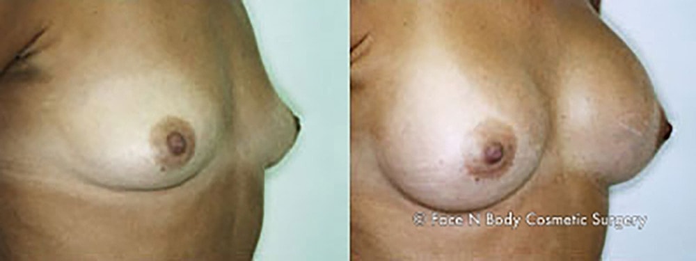Breast Augmentation Before & After