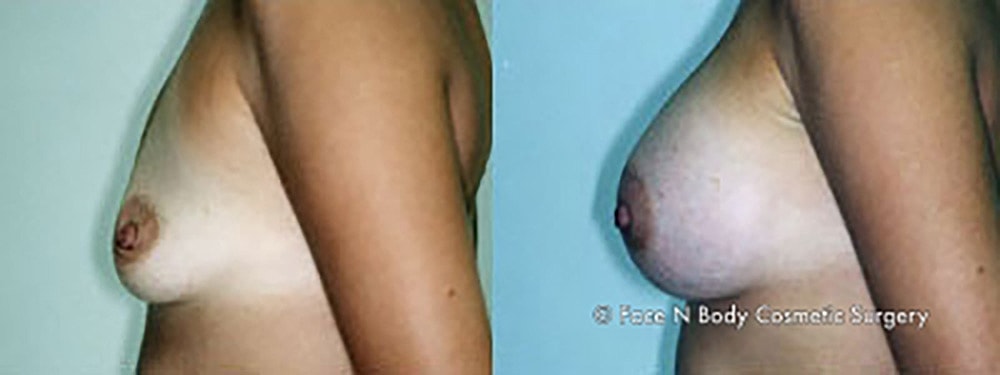 Breast Augmentation Before & After