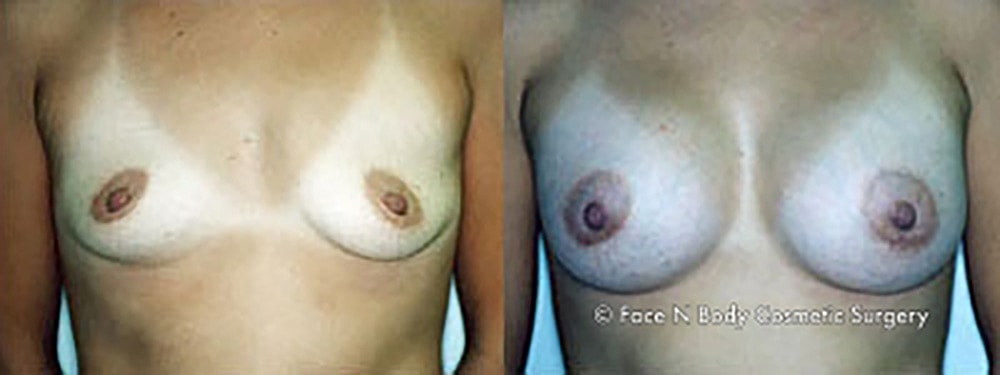 Breast Augmentation Before & After