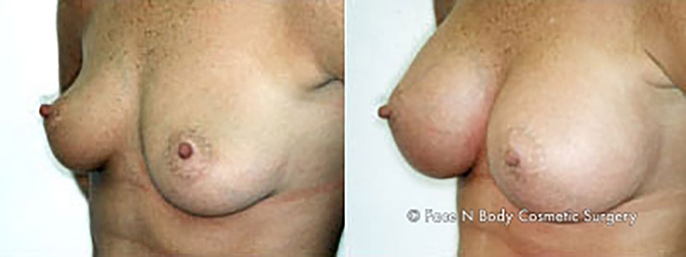 Breast Augmentation Before & After