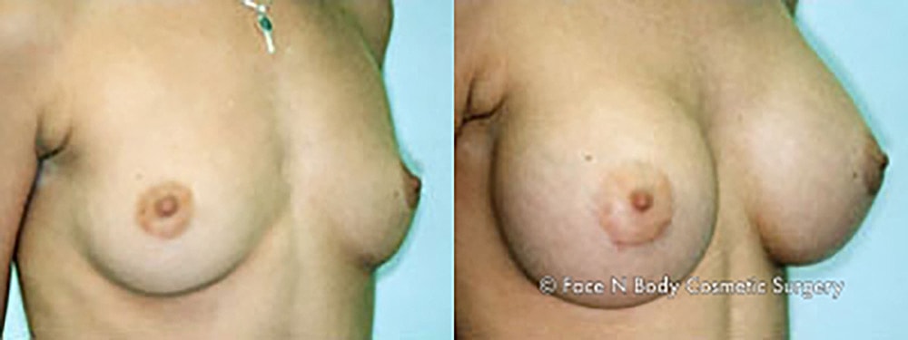 Breast Augmentation Before & After