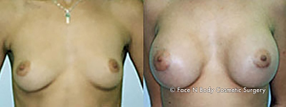 Breast Augmentation Before & After
