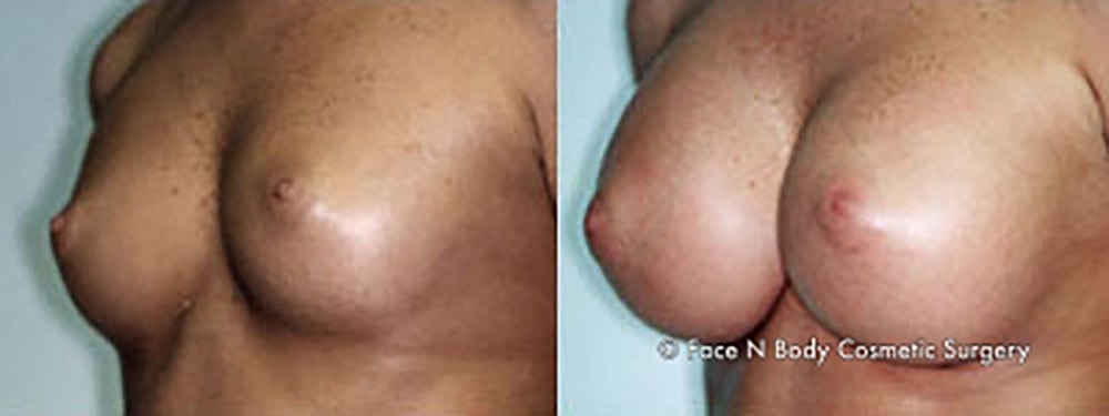 Breast Augmentation Before & After