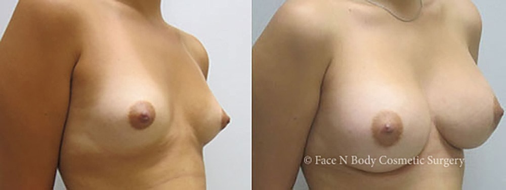 Breast Augmentation Before & After