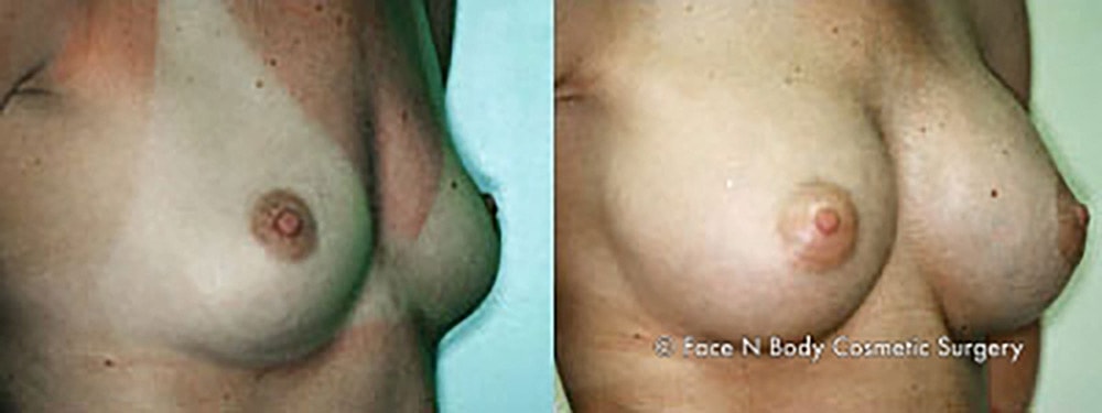 Breast Augmentation Before & After