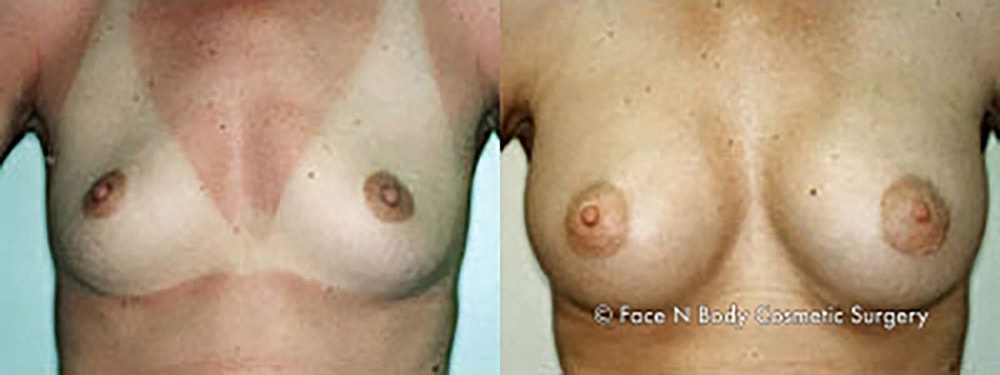 Breast Augmentation Before & After