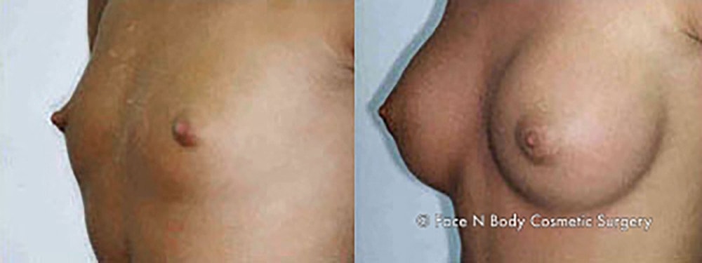 Breast Augmentation Before & After