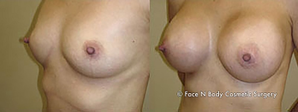 Breast Augmentation Before & After