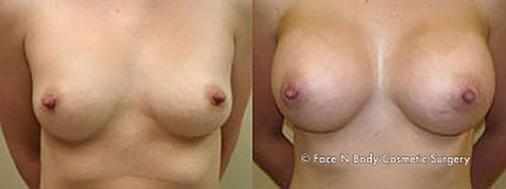 Breast Augmentation Before & After