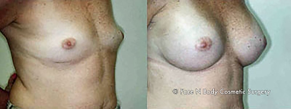 Breast Augmentation Before & After