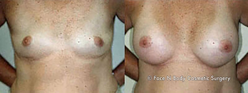 Breast Augmentation Before & After
