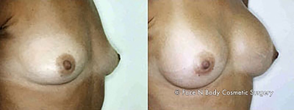 Breast Augmentation Before & After