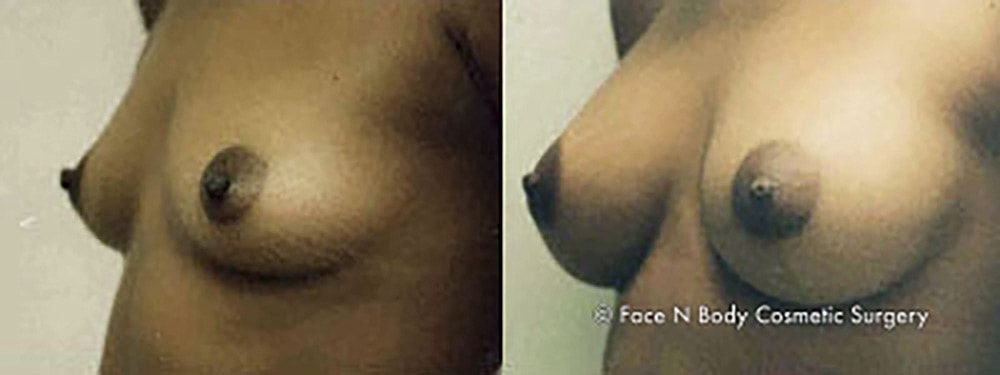 Breast Augmentation Before & After