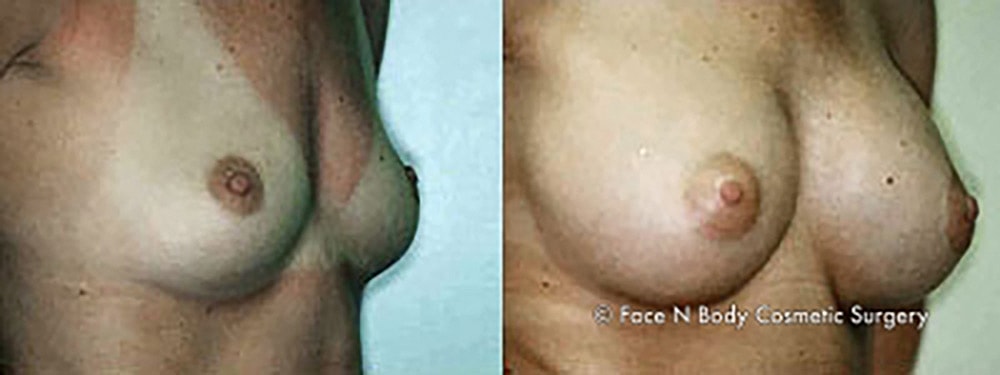 Breast Augmentation Before & After
