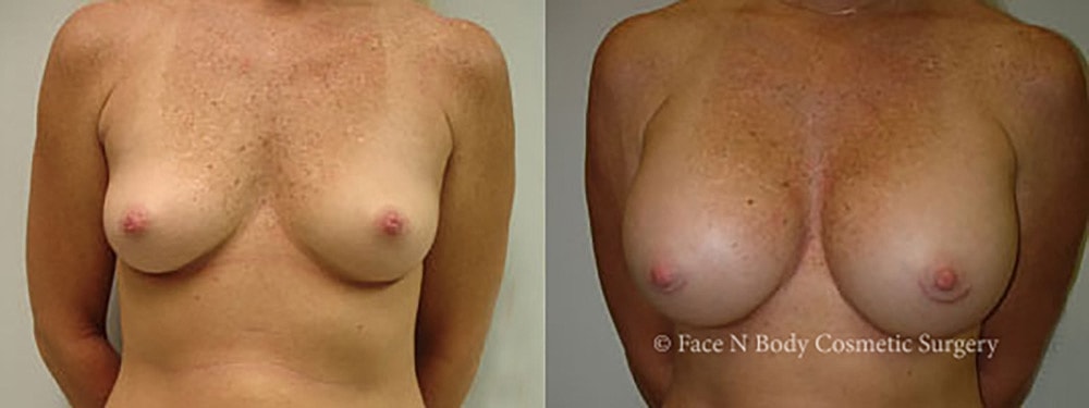Breast Augmentation Before & After