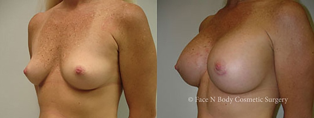 Breast Augmentation Before & After