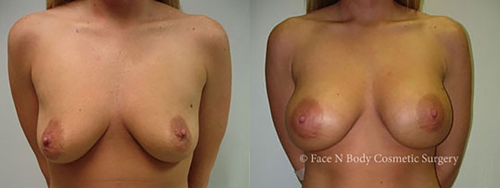 Breast Augmentation Before & After