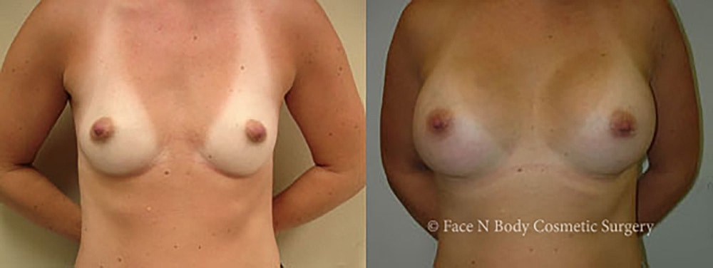 Breast Augmentation Before & After