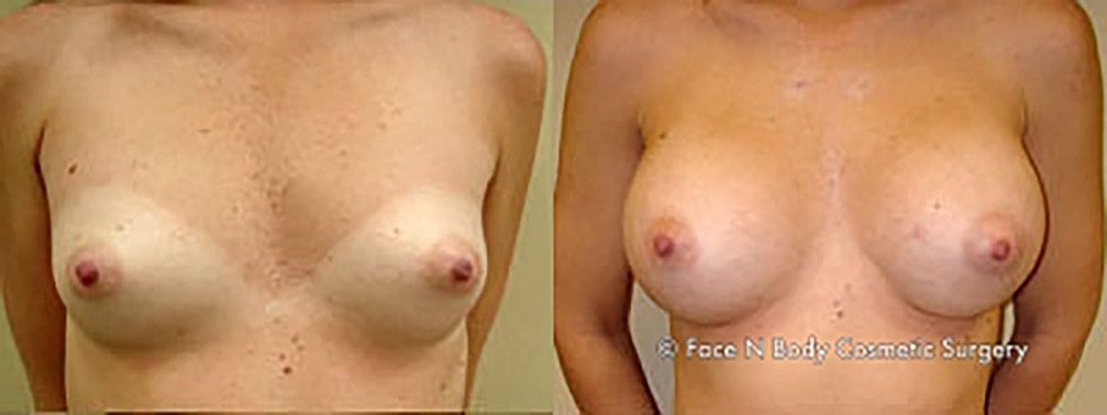 Breast Augmentation Before & After