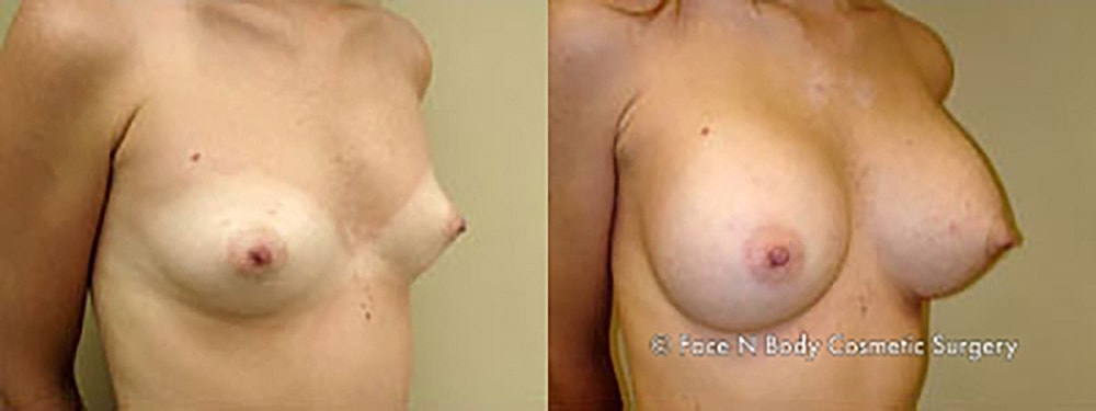 Breast Augmentation Before & After