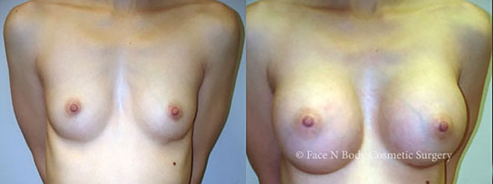 Breast Augmentation Before & After