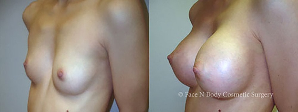 Breast Augmentation Before & After