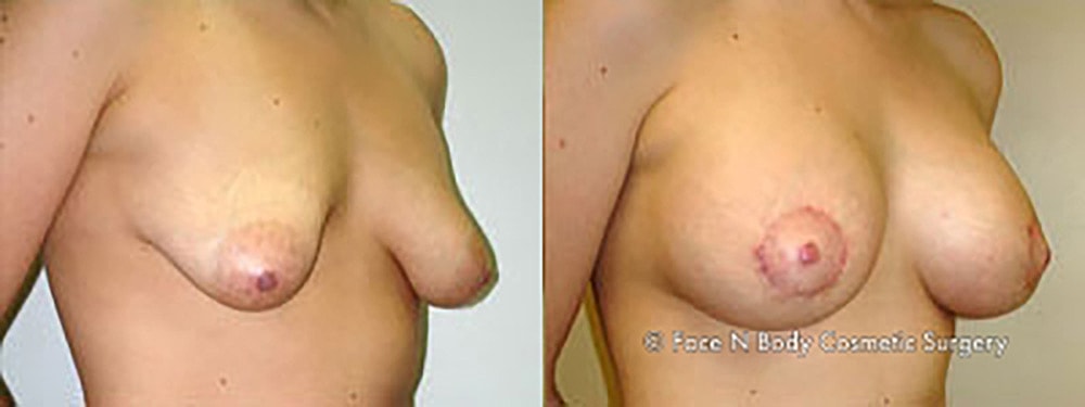 Breast Augmentation Before & After