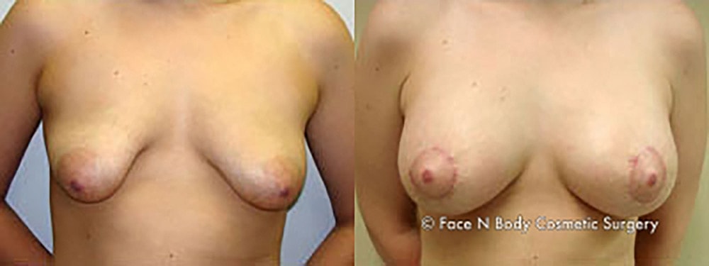 Breast Augmentation Before & After