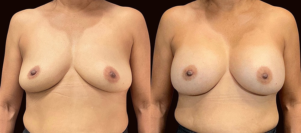 Breast enhancement before and after photos.