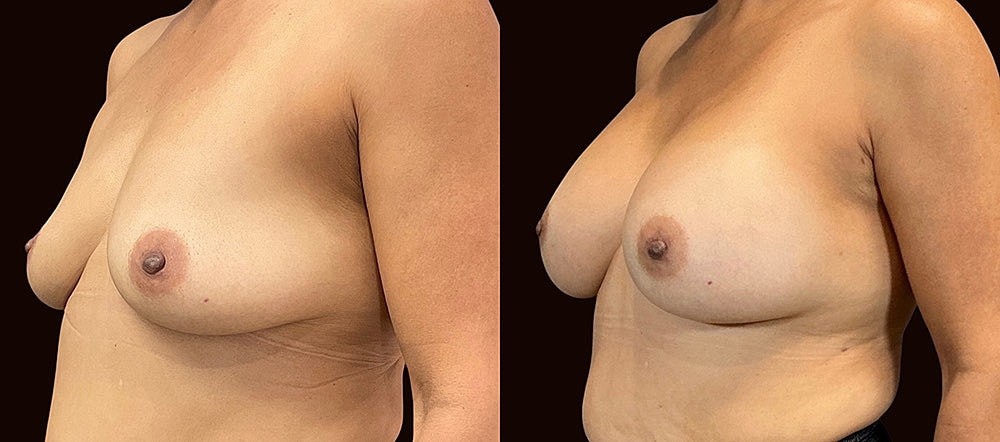 Before and after breast appearance comparison.