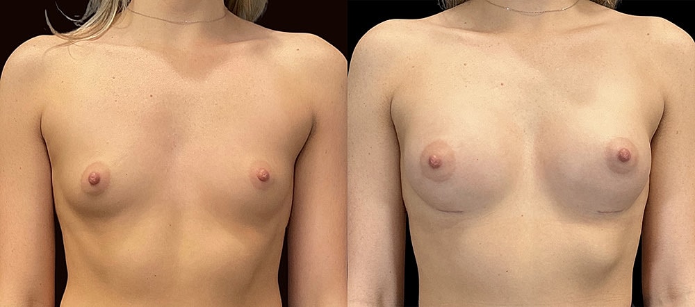 Before and after breast augmentation comparison image